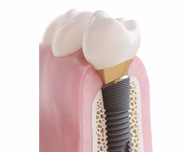 Choosing a Professional for Your Dental Implants in Weston