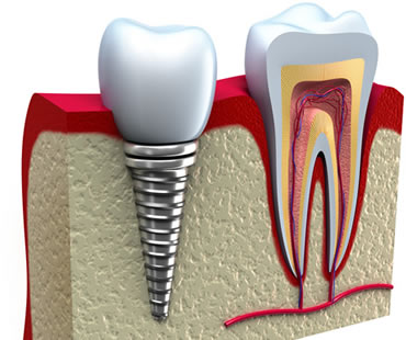 Private: Reaping the Benefits of Dental Implants
