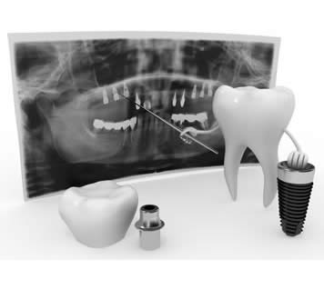 Preserving Bone With Dental Implants
