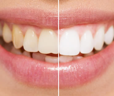 Dental Veneers vs. Teeth Whitening: Pros and Cons