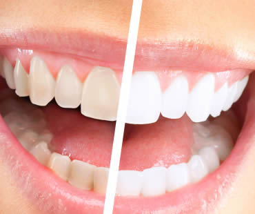 Are You Preparing to Whiten Your Teeth?
