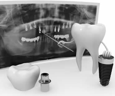 Private: Recommended Diet Following Dental Implant Surgery