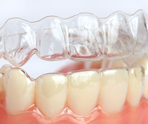 Link to more info about Invisalign