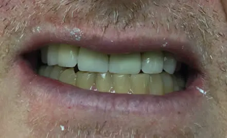 teeth after cosmetic dentistry - Dave