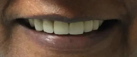 teeth after cosmetic dentistry - mark