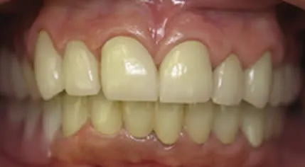 teeth after cosmetic dentistry - mary