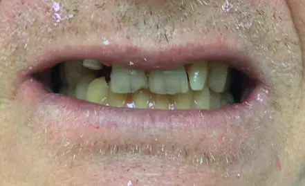 teeth before cosmetic dentistry - Dave