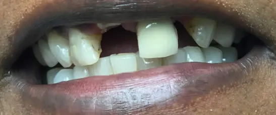 teeth before cosmetic dentistry - mark