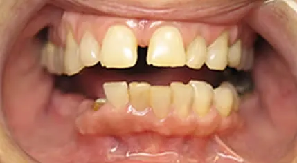 teeth before cosmetic dentistry - mary