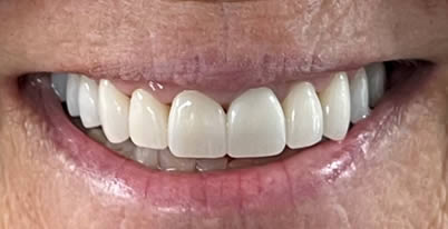 cosmetic-dentistry-patient-after-closeup