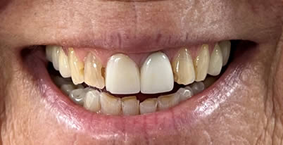 cosmetic-dentistry-patient-before-closeup