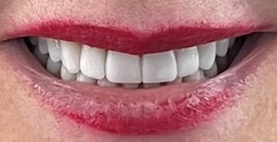 weston cosmetic dentistry patient after f