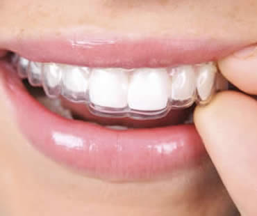 Invisalign and Older Smiles