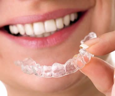 Adults: Living with Invisalign